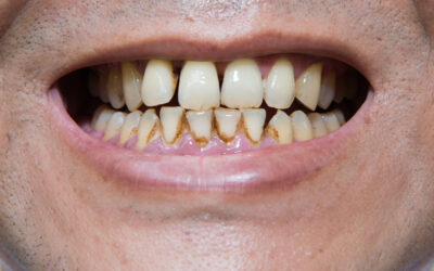 Can Methadone Rot Your Teeth? Exploring Dental Health Concerns